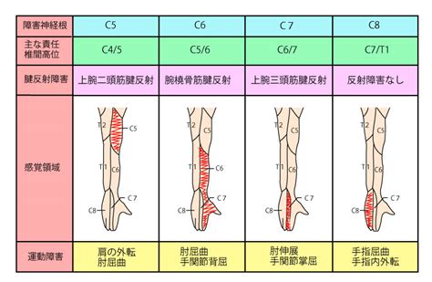 頸部・腰部の神経根症状イラスト（脊髄神経の支配領域を参考に）