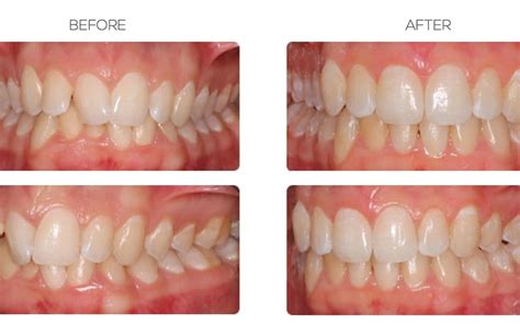 Before And After Magic Transformational Power Of Braces On Teeth