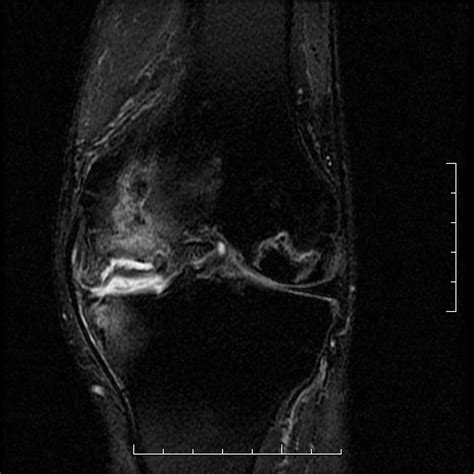 Avascular Necrosis And Osteochondral Fracture Of The Knee Image