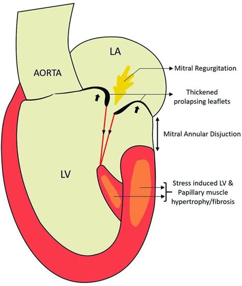 Diagrammatic Representation Of Pathophysiology Of Arrhythmic Mitral