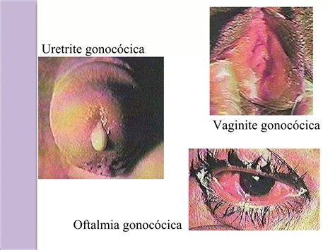 Doen As Sexualmente Transmiss Veis Dsts Ppt