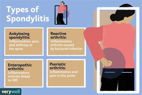 Types Of Spondylitis Arthritis In The Back