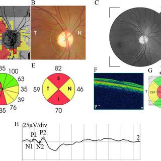 Autosomal Dominant Optic Atrophy Adoa Pedigree Squares And Circles