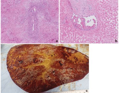 Explanted Allograft A Explanted Allograft With Massive Hepatic