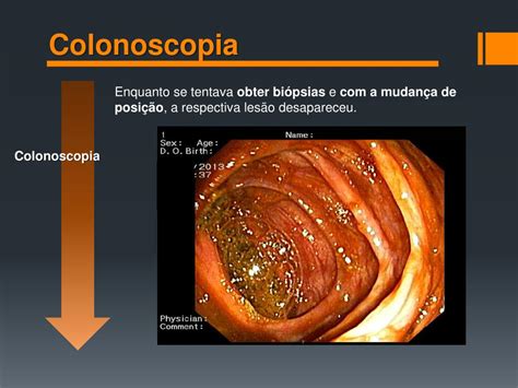 Ppt Invagina O Intestinal De P Lipo Fibr Ide Inflamat Rio Do Leon