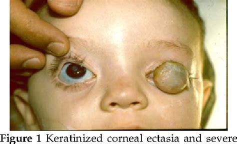 Figure 1 From Congenital Corneal Staphyloma Semantic Scholar