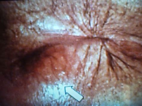 Blog Da Sa De Gay Abscesso Anal Diagnostico E Tratamenro