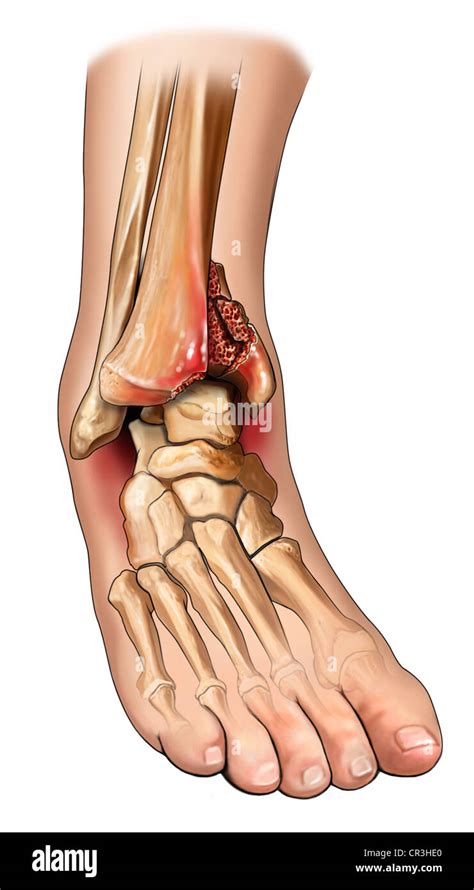 Hinterer Malleolus Fotos Und Bildmaterial In Hoher Aufl Sung Alamy