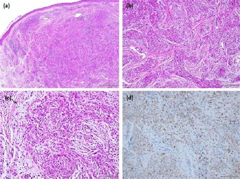 Arborizing Vessels Under Dermoscopy A Case Of Cellular Neurothekeoma Instead Of Basal Cell