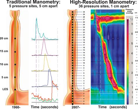 A Primer Of High Resolution Esophageal Manometry Seminars In Thoracic