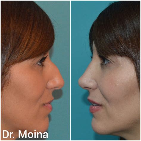 Rinoplastia Antes Y Despu S Rinoplastia Antes Y Despu S Dr Moina