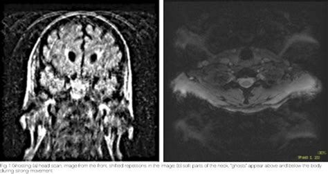 Motion Artifacts In Radiology