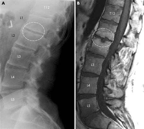 Cervical Ankylosing Spondylitis X Ray