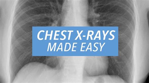 Chest X Rays Made Easy Learn To Read A Cxr In 10 Minutes Youtube