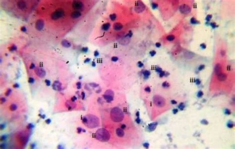 sampled HSIL study group smear cytomorphology. HSIL smear displaying ...