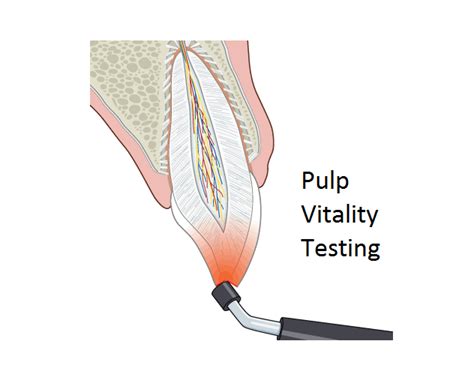 Pulp Vitality Test News Dentagama