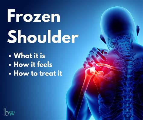 Frozen Shoulder The Bodyworks Clinic Marbella Spain