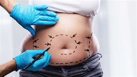 Liposuction Surgery Procedure Complications And Its Results