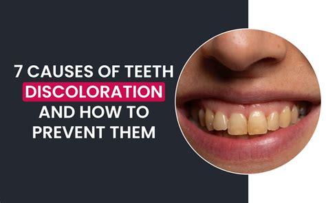 Causes Of Teeth Discoloration And How To Prevent Them