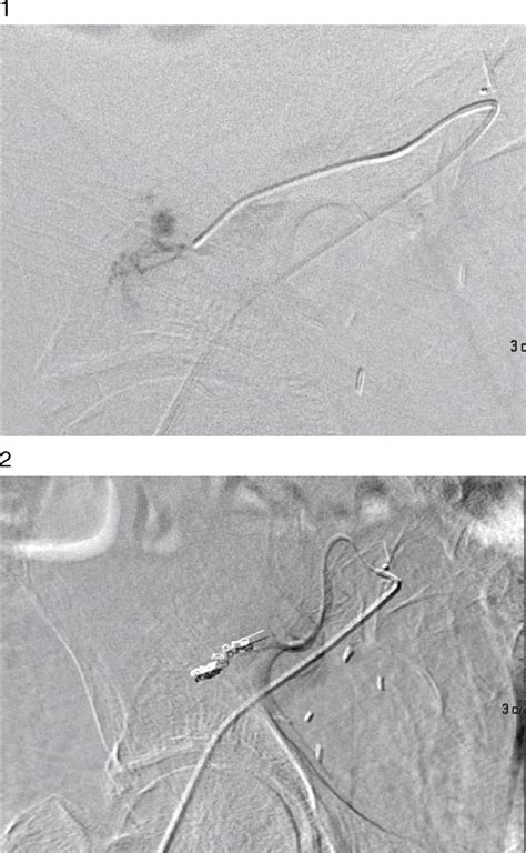 And 2 Arteriogram Of The Renal Graft With Contrast Extravasation In A Download Scientific