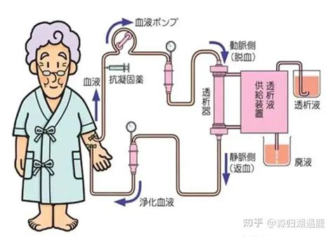 详解血液透析与血液透析滤过的区别 知乎