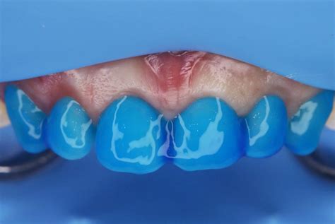 Simplified Diastema Closure