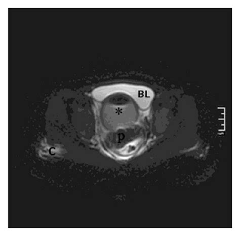 A Axial T2 Weighted Fse Image Material With Air Fluid Level Shows