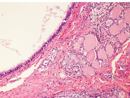 Thyroglossal Duct Cyst Histology