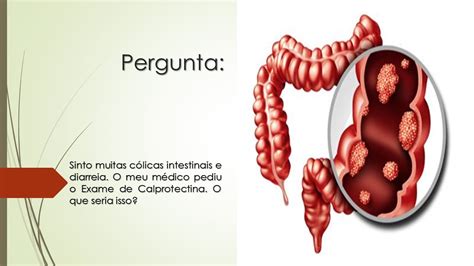 Tenho C Licas Intestinais E Diarreia O M Dico Pediu Exame De