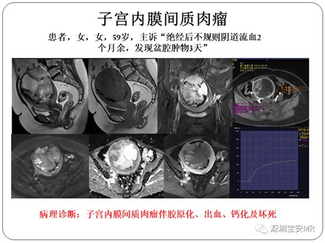 子宫内膜癌mri诊断及鉴别诊断 好医术早读文章 好医术 赋能医生守护生命