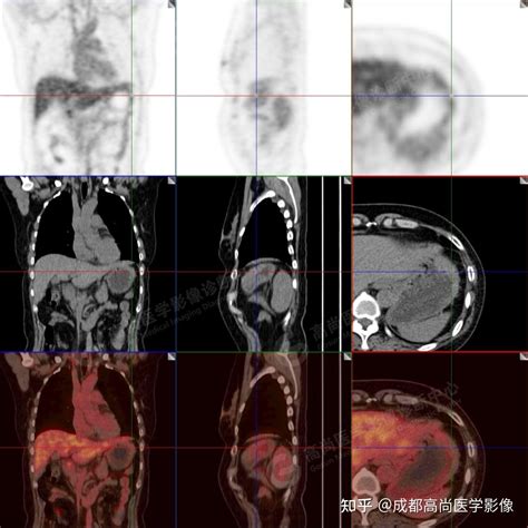 Malt F Fdg Pet Ct