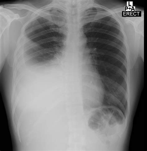 Pleural Effusion Uni Clinic