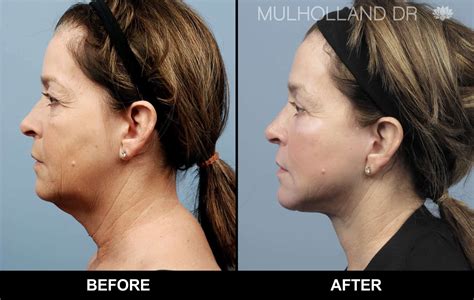 Cheek Lift Surgery Mid Facelift Toronto Plastic Surgeons