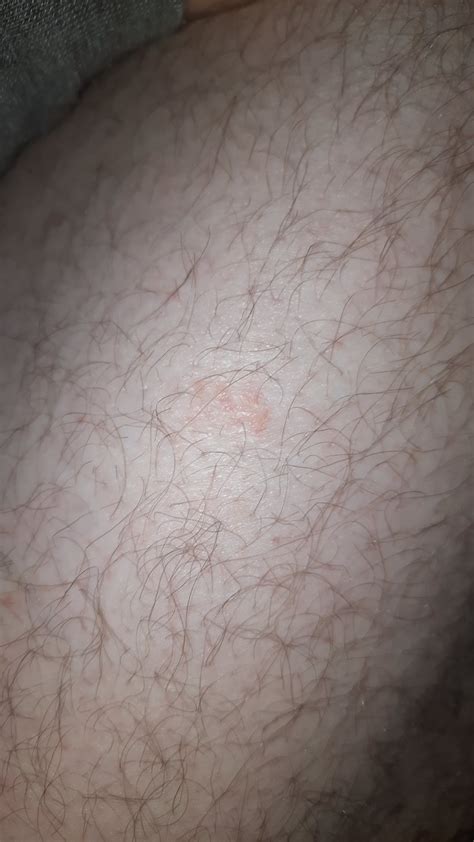 Red Patch On My Leg Is Scaly Keeps Coming Back Potential Skin Cancer R Dermatologyquestions