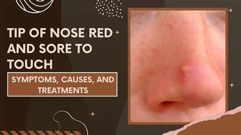 Tip Of Nose Red And Sore To Touch Symptoms Causes And Treatments