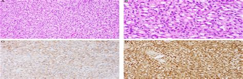 Ovarian Signet Ring Stromal Tumor A Morphologic Immunohist The