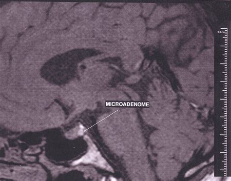 Pituitary adenoma - Wikipedia