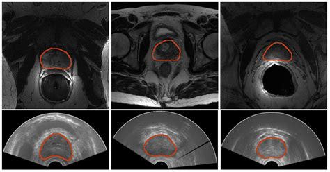 Samples Of Images From Both Modalities Top Prostate Mri From Left