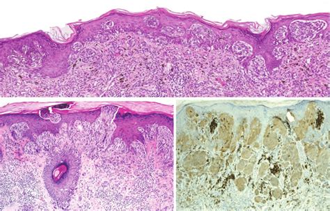 Spitz Nevus With Ros1 Fusion A Ros1 Fused Melanocytic Proliferations Download Scientific