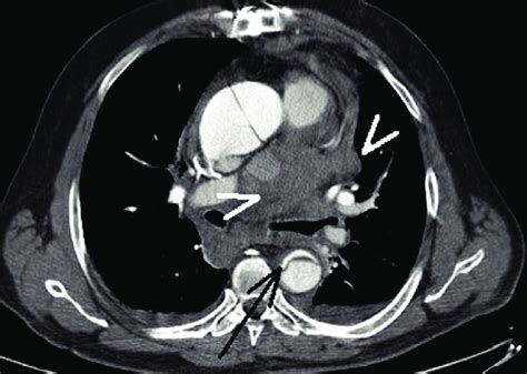 Contrast Enhanced Axial Ct Scan Shows Bilateral Minimal Pleural