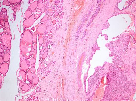 Atypical Presentation Of Oncocytic Parathyroid Adenoma Masquerading As