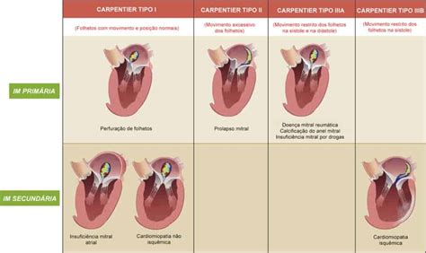 Regurgitação Mitral Discreta Sintomas BRAINCP