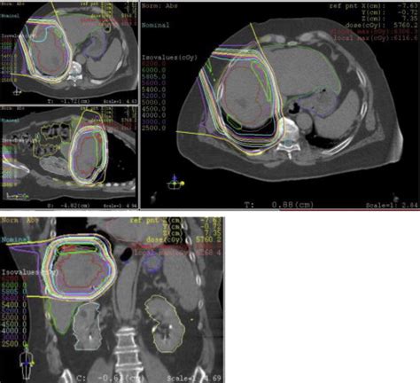 An Emerging Role for Radiation Therapy in the Treatment of Hepatocellular Carcinoma and ...