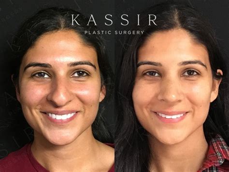 Ethnic Female Rhinoplasty Indian Rhinoplasty Kassir Plastic Surgery