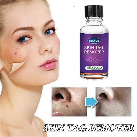 Skin Tag Remover Mole Wart Remover Effectively Remove Common And