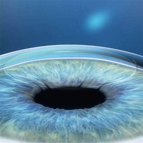 Smile Calgary Western Laser Eye Associates