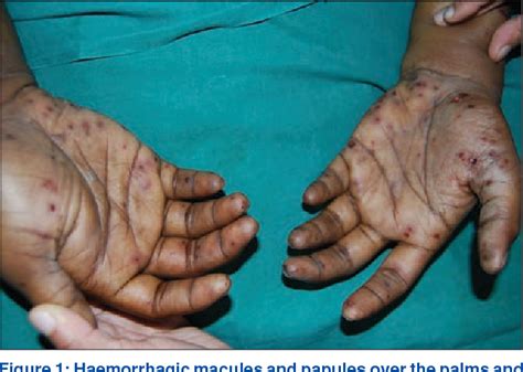 Figure 1 From Janeway Lesions Revisited Semantic Scholar