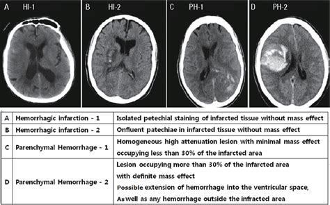 Hemorrhagic Stroke Mri