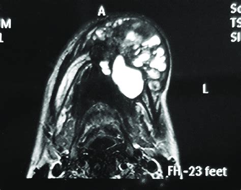 MRI revealed well-defined heterogeneous multiloculated enhancing solid ...