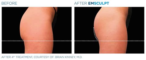 Emsculpt Before and After | Real Patient Results